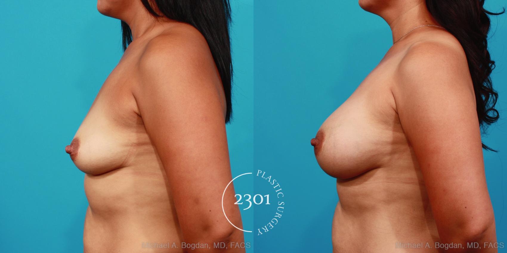 Before & After Saline Implants Case 353 View #2 View in Fort Worth, Plano, & Frisco, Texas