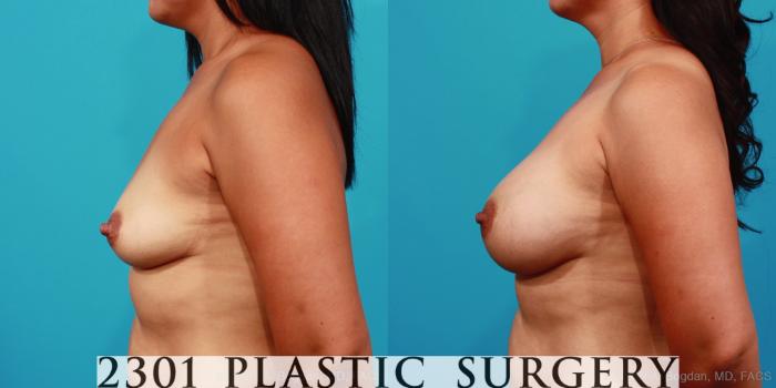 Before & After Saline Implants Case 353 View #2 View in Fort Worth, Plano, & Frisco, Texas