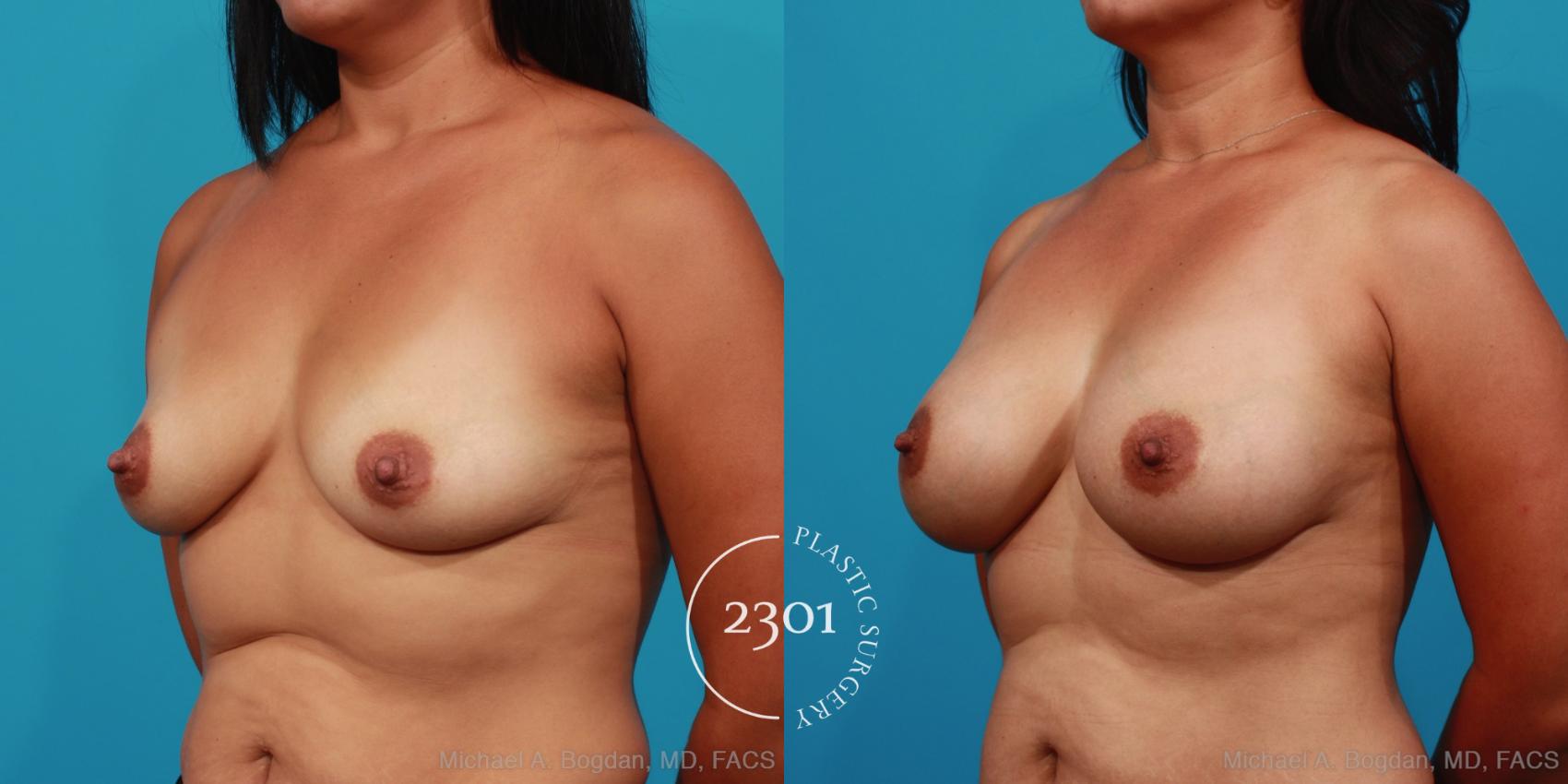 Before & After Saline Implants Case 353 View #3 View in Fort Worth, Plano, & Frisco, Texas