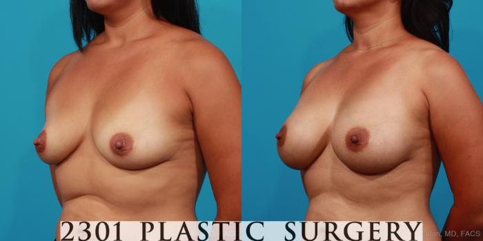 Before & After Breast Augmentation Case 353 View #3 View in Fort Worth, Plano, & Frisco, Texas