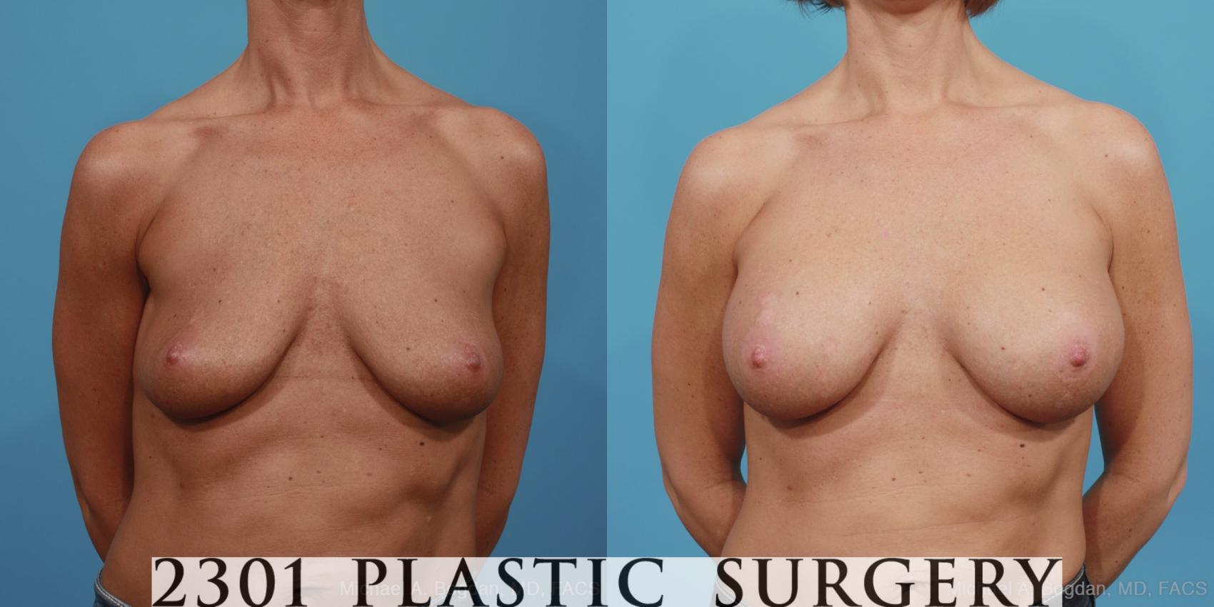Before & After Saline Implants Case 391 View #1 View in Fort Worth, Plano, & Frisco, Texas
