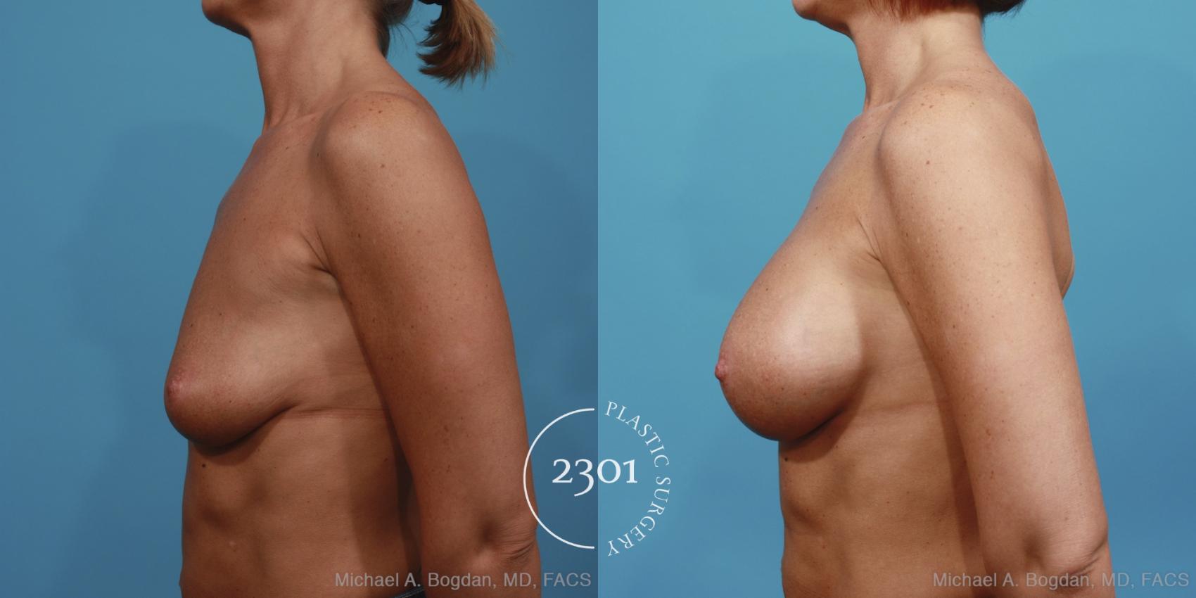 Before & After Saline Implants Case 391 View #2 View in Fort Worth, Plano, & Frisco, Texas
