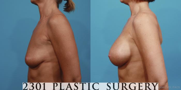 Before & After Saline Implants Case 391 View #2 View in Fort Worth, Plano, & Frisco, Texas