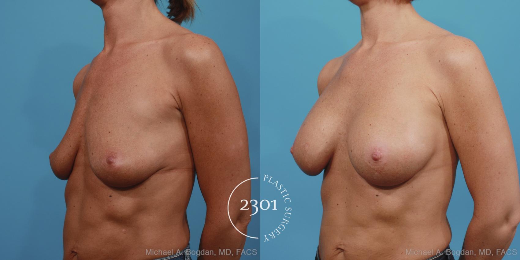 Before & After Saline Implants Case 391 View #3 View in Fort Worth, Plano, & Frisco, Texas