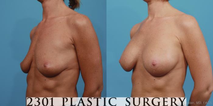 Before & After Saline Implants Case 391 View #3 View in Fort Worth, Plano, & Frisco, Texas