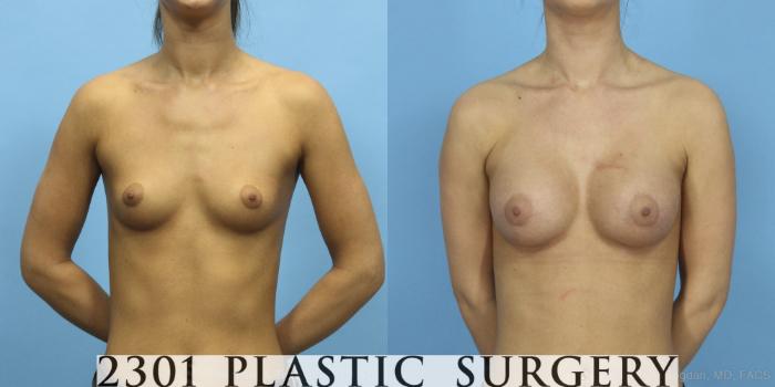 Before & After Saline Implants Case 427 View #1 View in Fort Worth, Plano, & Frisco, Texas