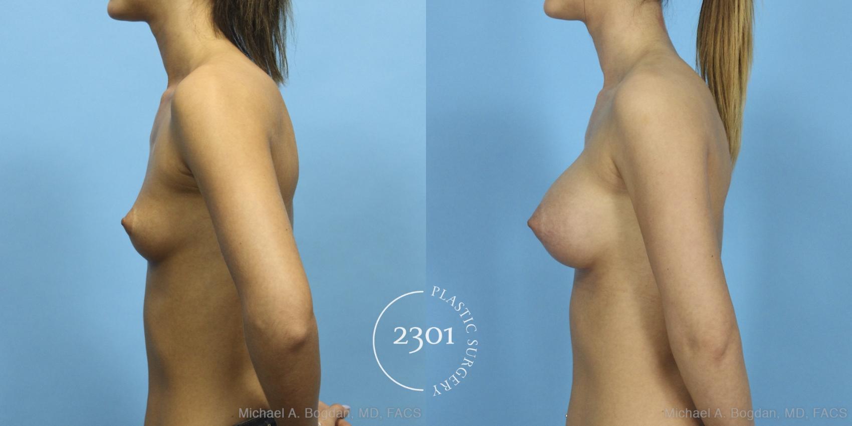 Before & After Saline Implants Case 427 View #2 View in Fort Worth, Plano, & Frisco, Texas