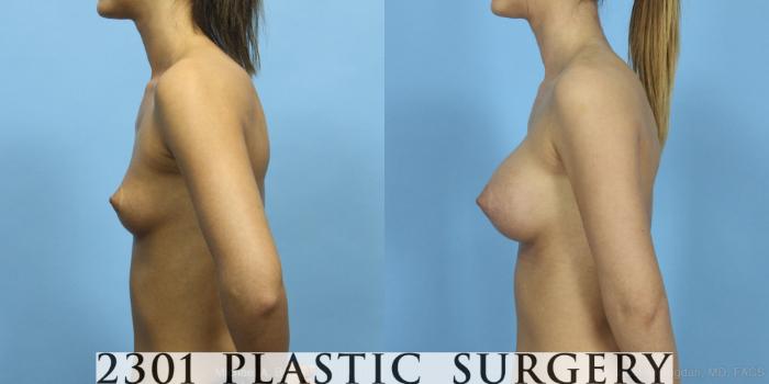 Before & After Saline Implants Case 427 View #2 View in Fort Worth, Plano, & Frisco, Texas