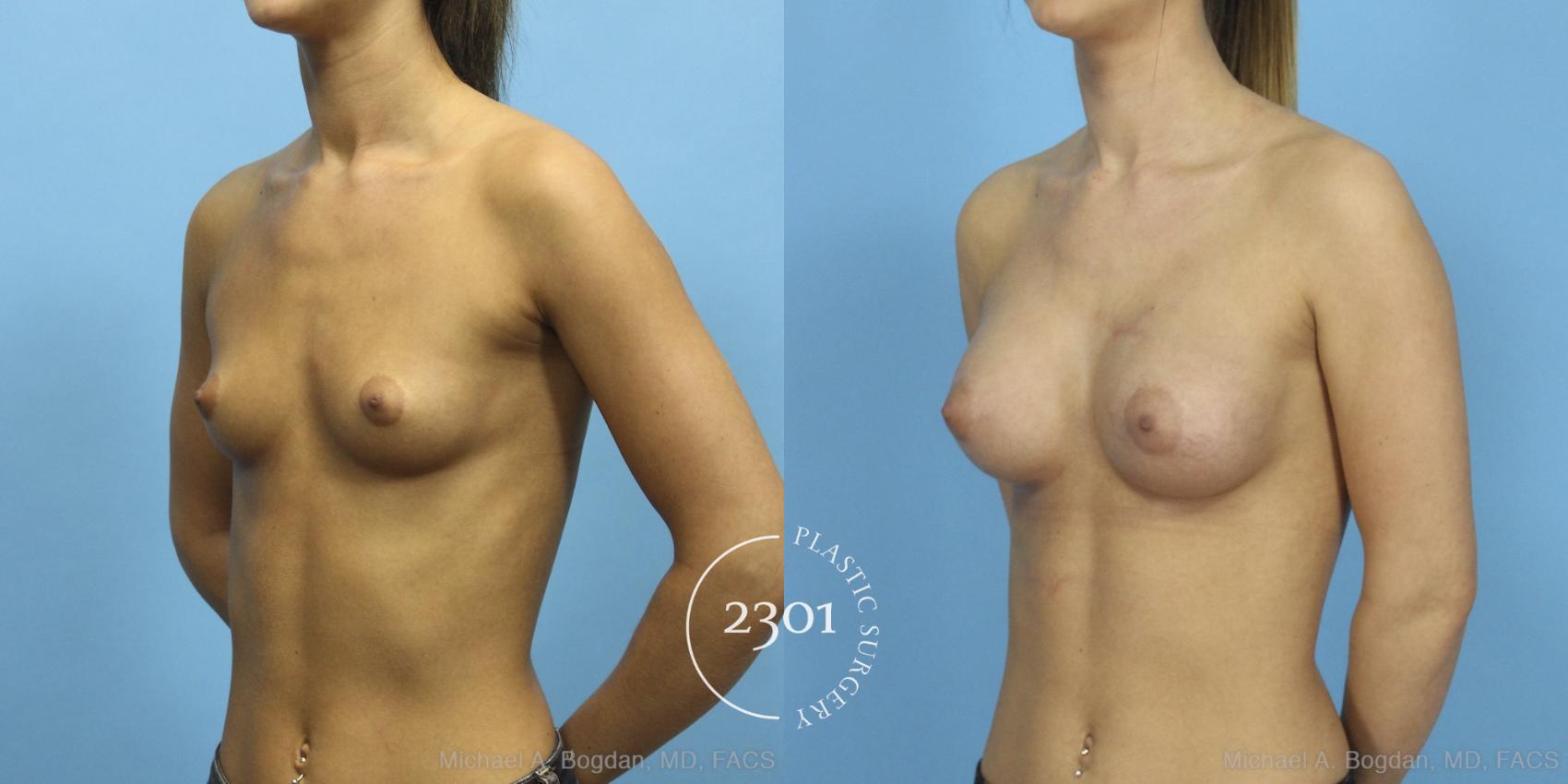 Before & After Saline Implants Case 427 View #3 View in Fort Worth, Plano, & Frisco, Texas