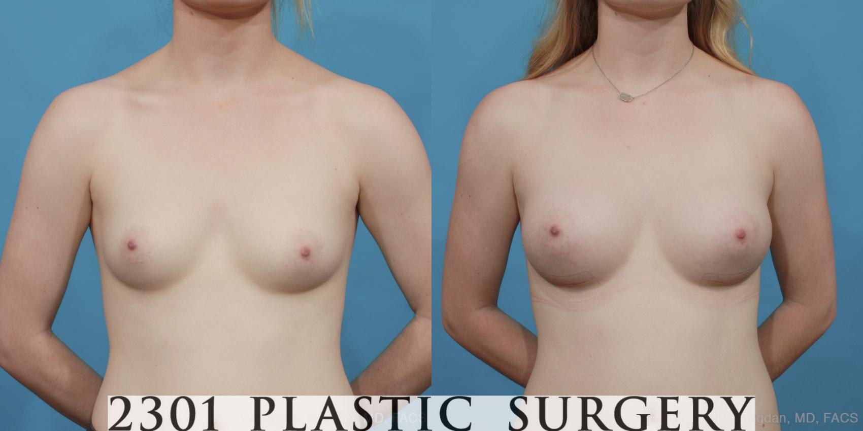Before & After Saline Implants Case 449 View #1 View in Fort Worth, Plano, & Frisco, Texas