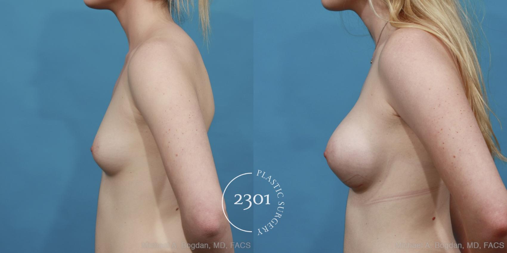 Before & After Saline Implants Case 449 View #3 View in Fort Worth, Plano, & Frisco, Texas