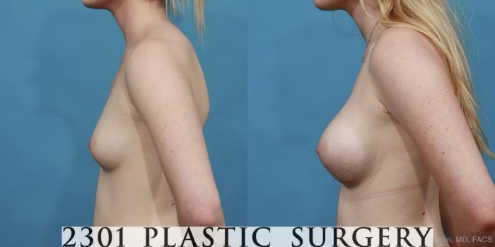 Before & After Saline Implants Case 449 View #3 View in Fort Worth, Plano, & Frisco, Texas