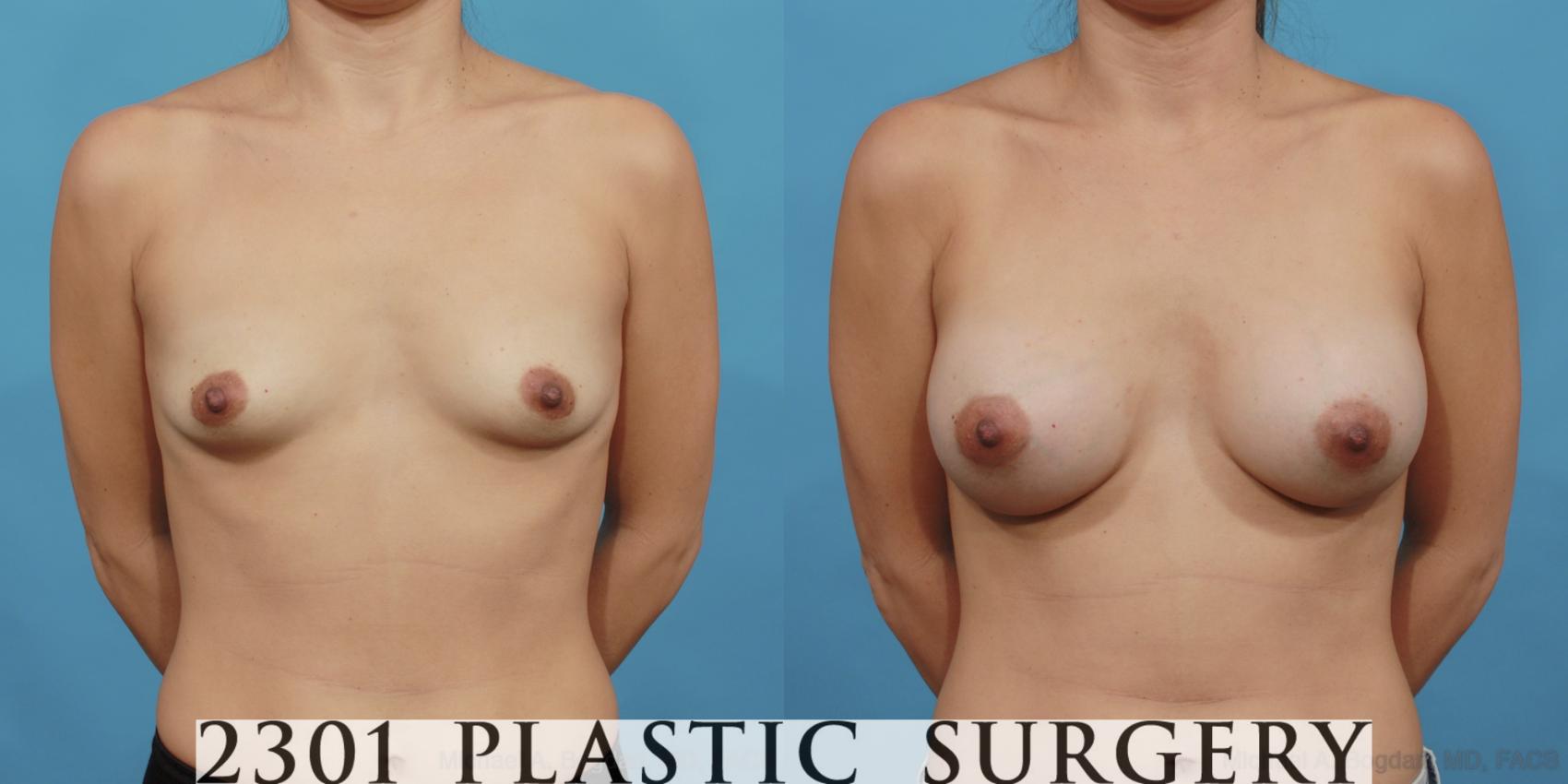 Before & After Saline Implants Case 493 View #1 View in Fort Worth, Plano, & Frisco, Texas
