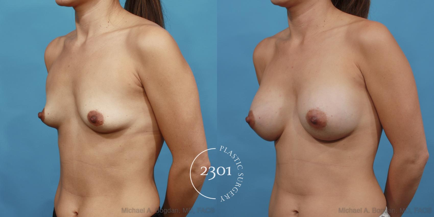 Before & After Saline Implants Case 493 View #2 View in Fort Worth, Plano, & Frisco, Texas