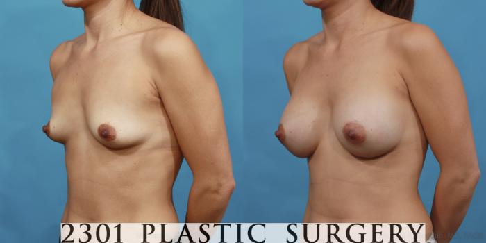 Before & After Saline Implants Case 493 View #2 View in Fort Worth, Plano, & Frisco, Texas