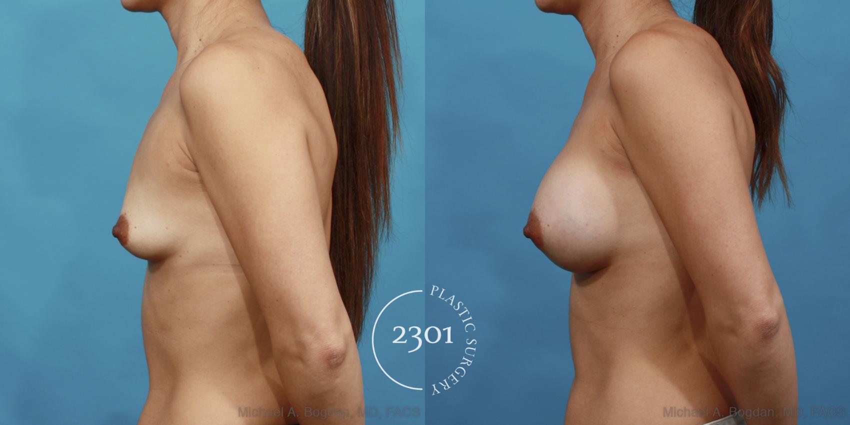 Before & After Saline Implants Case 493 View #3 View in Fort Worth, Plano, & Frisco, Texas
