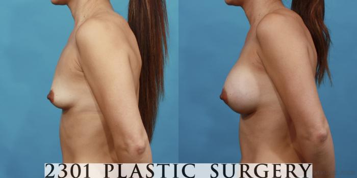 Before & After Saline Implants Case 493 View #3 View in Fort Worth, Plano, & Frisco, Texas