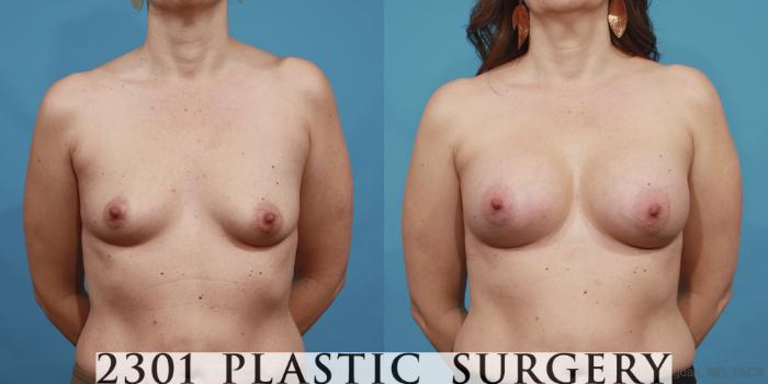 Before & After Saline Implants Case 604 View #1 View in Fort Worth, Plano, & Frisco, Texas