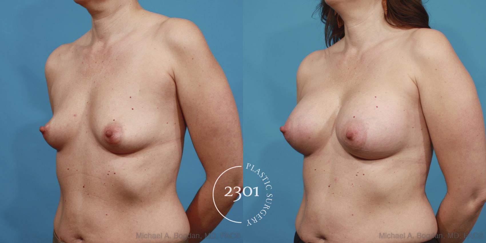 Before & After Saline Implants Case 604 View #2 View in Fort Worth, Plano, & Frisco, Texas