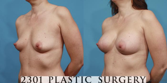 Before & After Saline Implants Case 604 View #2 View in Fort Worth, Plano, & Frisco, Texas