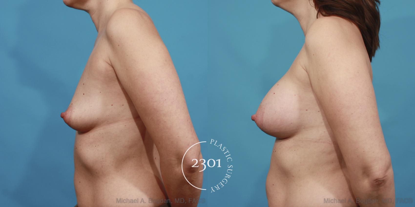 Before & After Saline Implants Case 604 View #3 View in Fort Worth, Plano, & Frisco, Texas