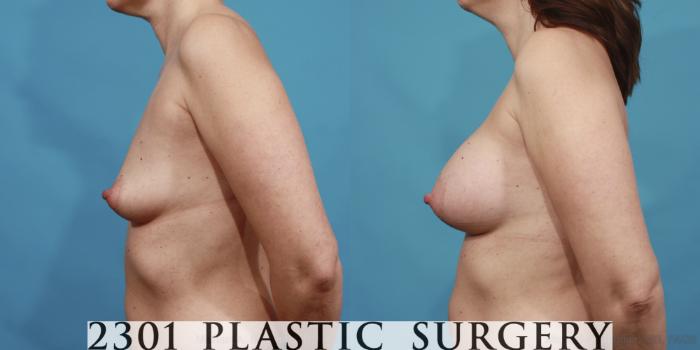 Before & After Saline Implants Case 604 View #3 View in Fort Worth, Plano, & Frisco, Texas