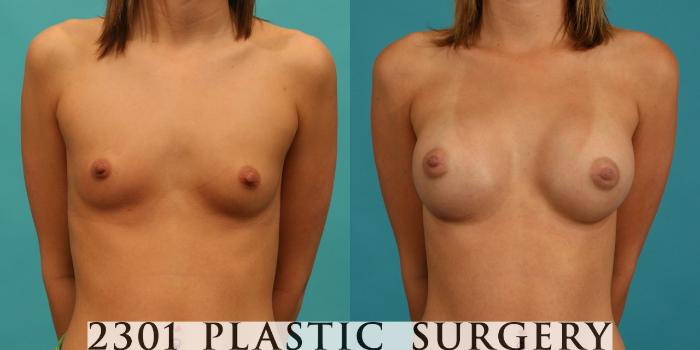 Before & After Saline Implants Case 62 View #1 View in Fort Worth, Plano, & Frisco, Texas