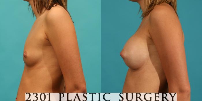 Before & After Saline Implants Case 62 View #2 View in Fort Worth, Plano, & Frisco, Texas