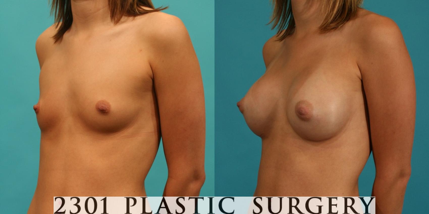 Before & After Saline Implants Case 62 View #3 View in Fort Worth & Frisco, Texas