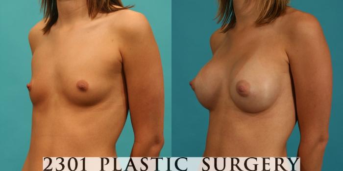 Before & After Saline Implants Case 62 View #3 View in Fort Worth, Plano, & Frisco, Texas