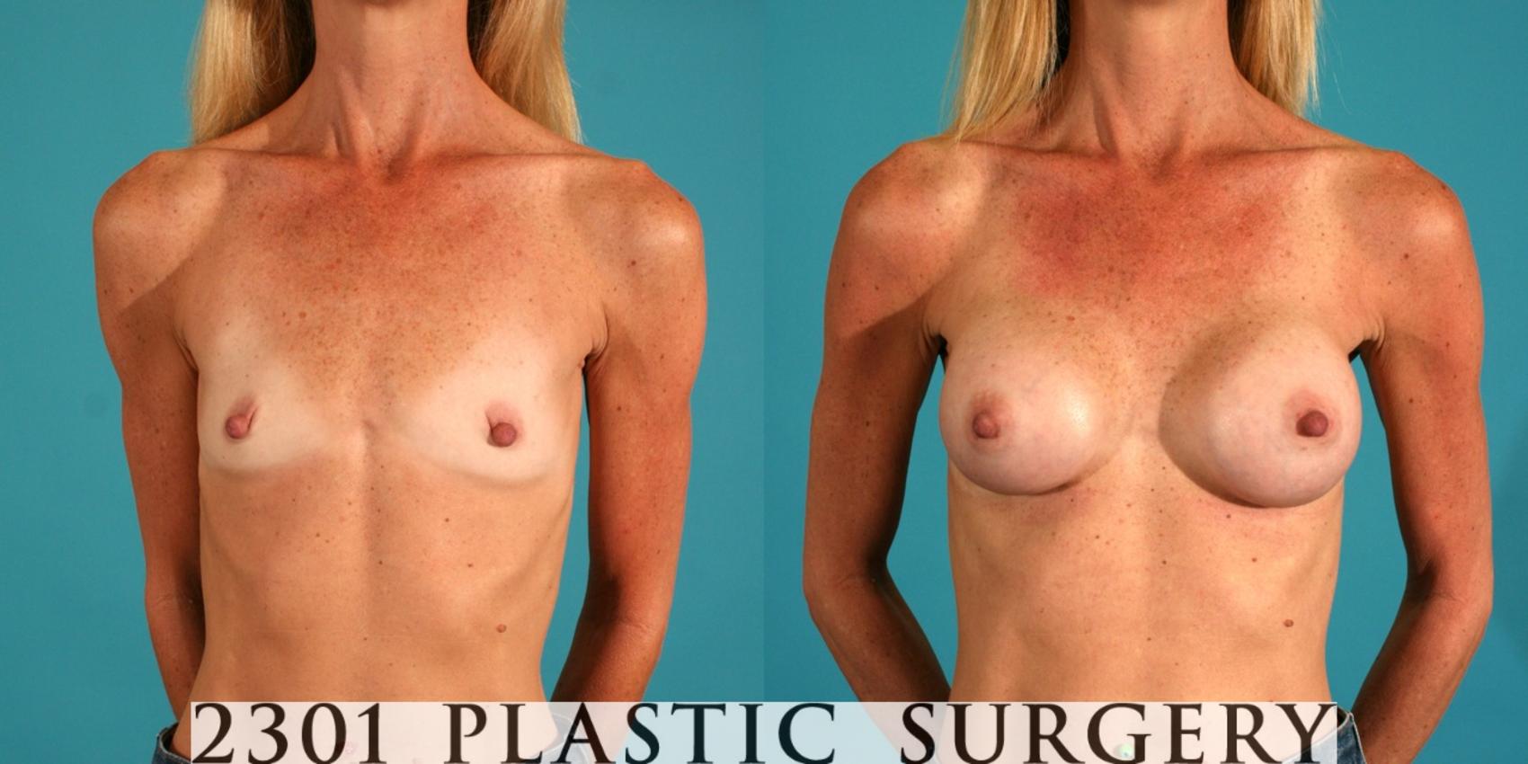 Before & After Saline Implants Case 65 View #1 View in Fort Worth, Plano, & Frisco, Texas