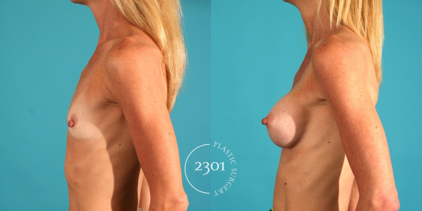 Before & After Saline Implants Case 65 View #2 View in Fort Worth, Plano, & Frisco, Texas