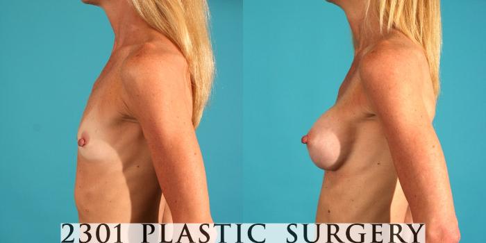 Before & After Saline Implants Case 65 View #2 View in Fort Worth, Plano, & Frisco, Texas