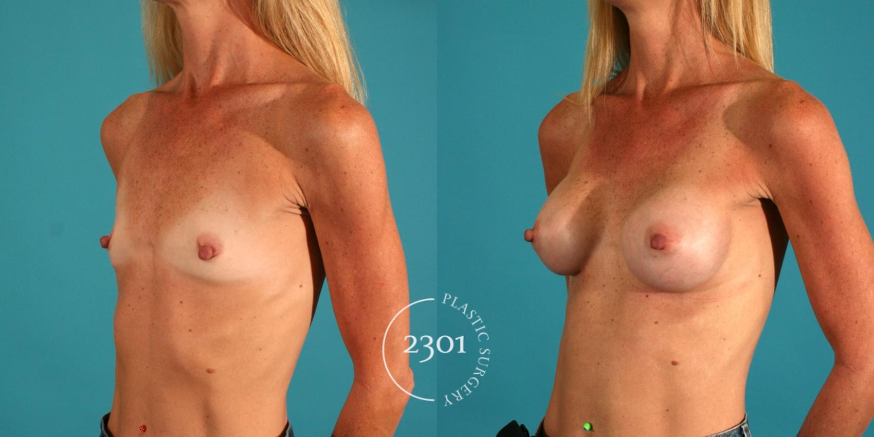 Before & After Saline Implants Case 65 View #3 View in Fort Worth, Plano, & Frisco, Texas