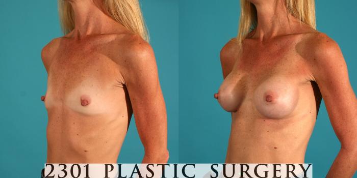 Before & After Saline Implants Case 65 View #3 View in Fort Worth, Plano, & Frisco, Texas