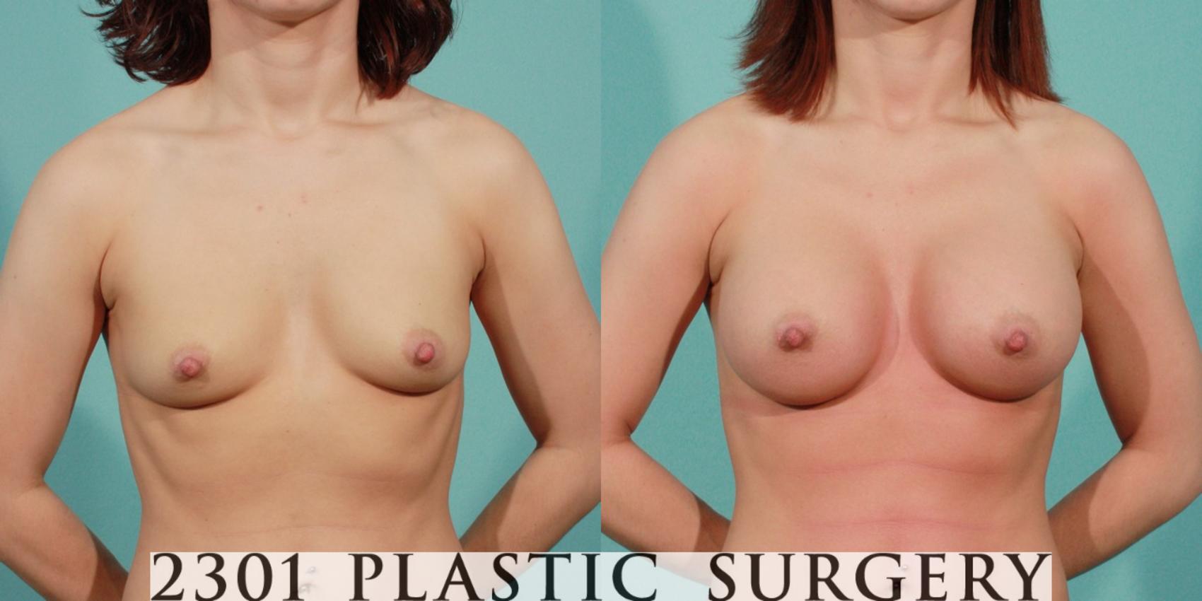Before & After Saline Implants Case 78 View #1 View in Fort Worth & Frisco, Texas