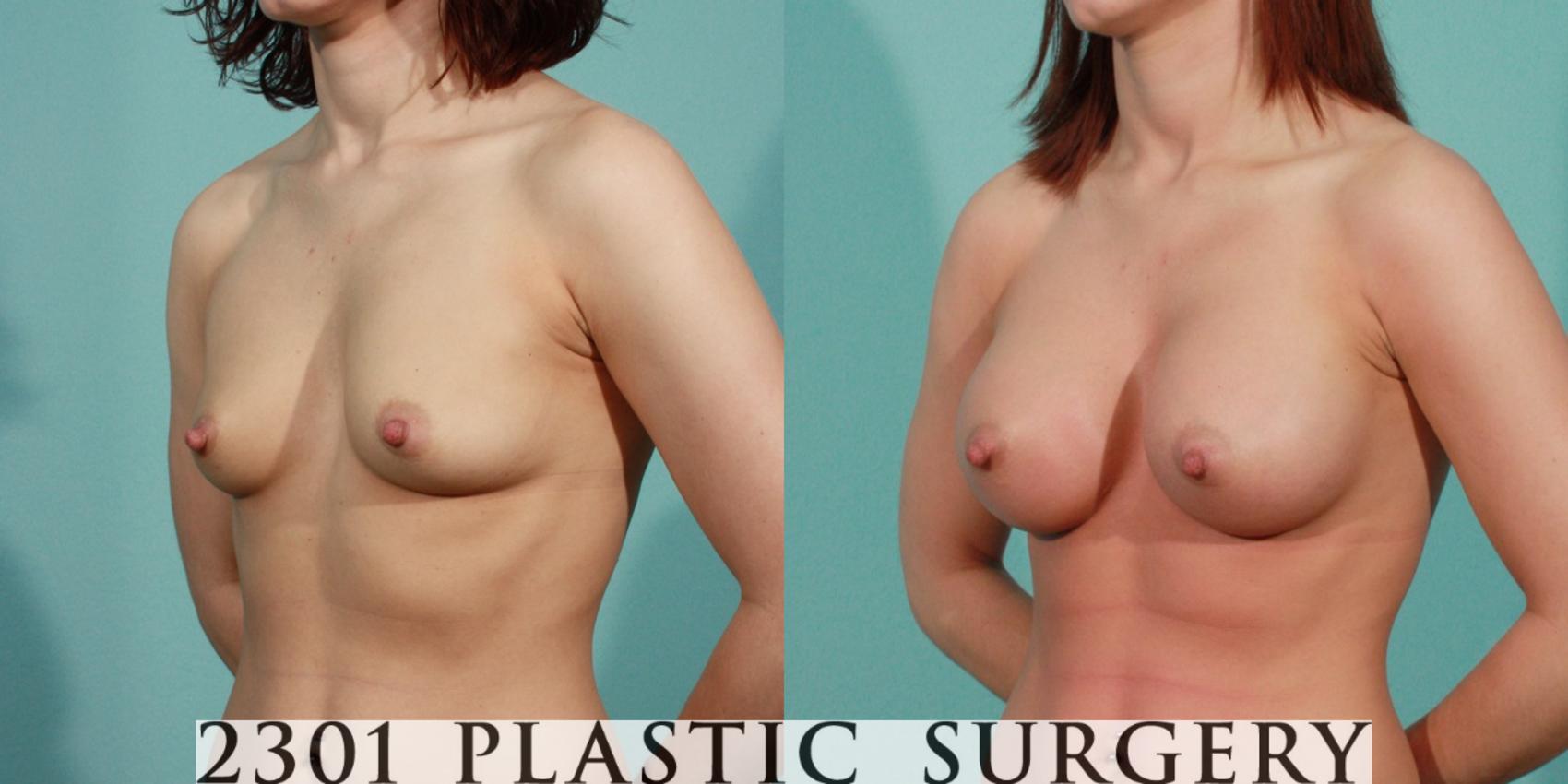 Before & After Saline Implants Case 78 View #3 View in Fort Worth & Frisco, Texas
