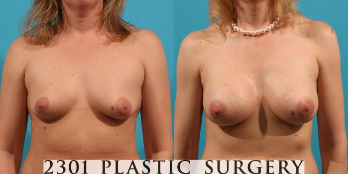 Before & After Saline Implants Case 8 View #1 View in Fort Worth, Plano, & Frisco, Texas