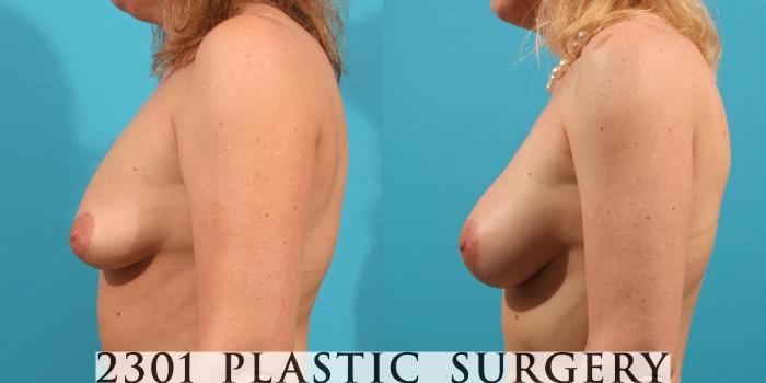 Before & After Breast Augmentation Case 8 View #2 View in Fort Worth, Plano, & Frisco, Texas