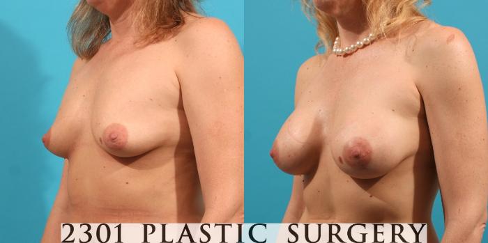Before & After Saline Implants Case 8 View #3 View in Fort Worth, Plano, & Frisco, Texas