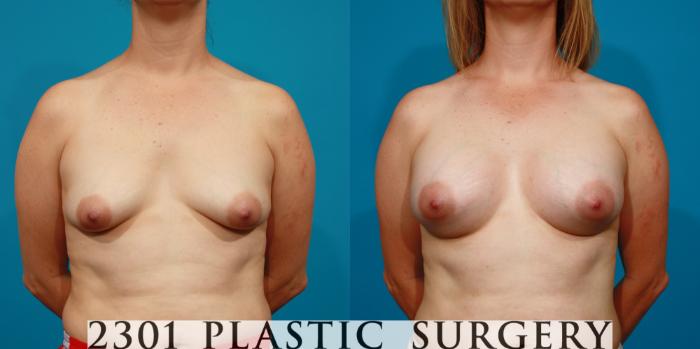 Before & After Saline Implants Case 85 View #1 View in Fort Worth, Plano, & Frisco, Texas