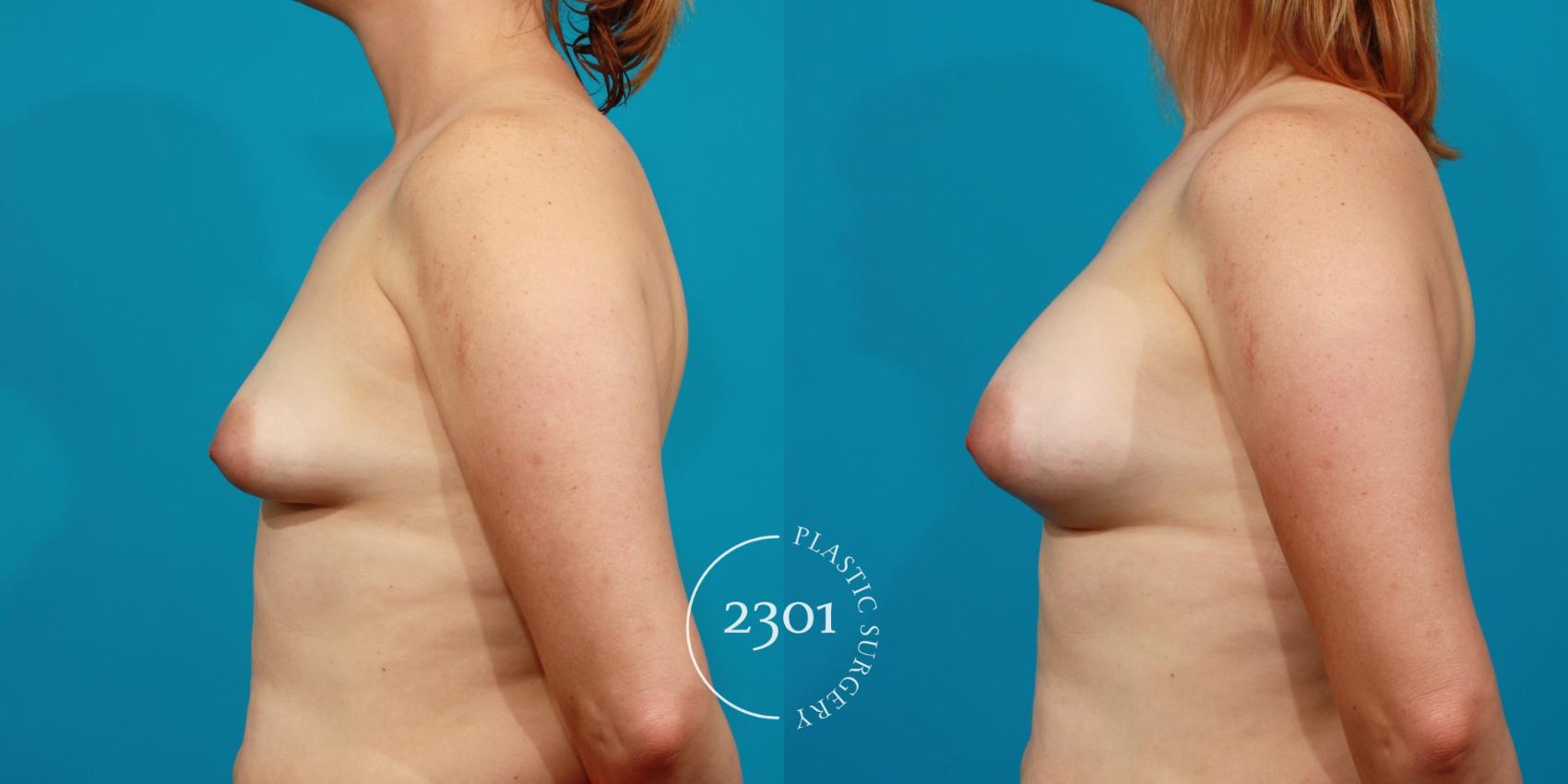 Before & After Saline Implants Case 85 View #2 View in Fort Worth, Plano, & Frisco, Texas