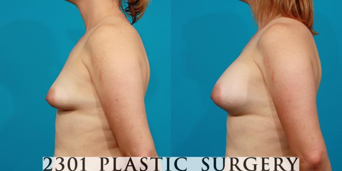 Before & After Saline Implants Case 85 View #2 View in Fort Worth, Plano, & Frisco, Texas