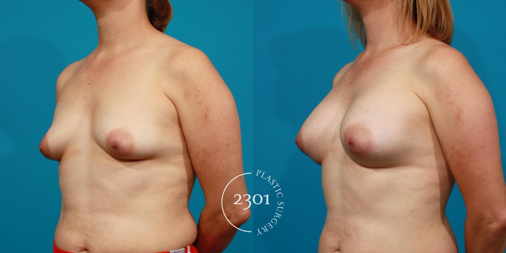 Before & After Saline Implants Case 85 View #3 View in Fort Worth, Plano, & Frisco, Texas