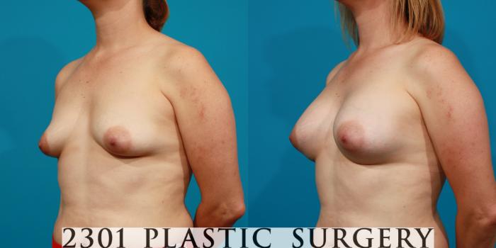 Before & After Saline Implants Case 85 View #3 View in Fort Worth, Plano, & Frisco, Texas