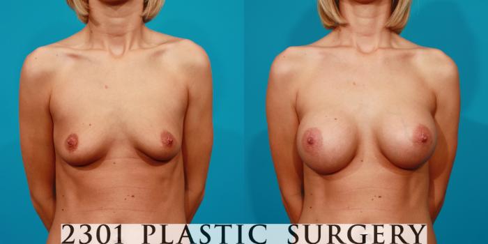 Before & After Saline Implants Case 86 View #1 View in Fort Worth, Plano, & Frisco, Texas