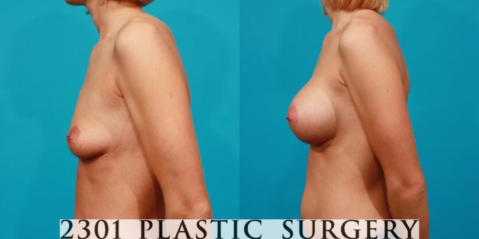 Before & After Saline Implants Case 86 View #2 View in Fort Worth, Plano, & Frisco, Texas