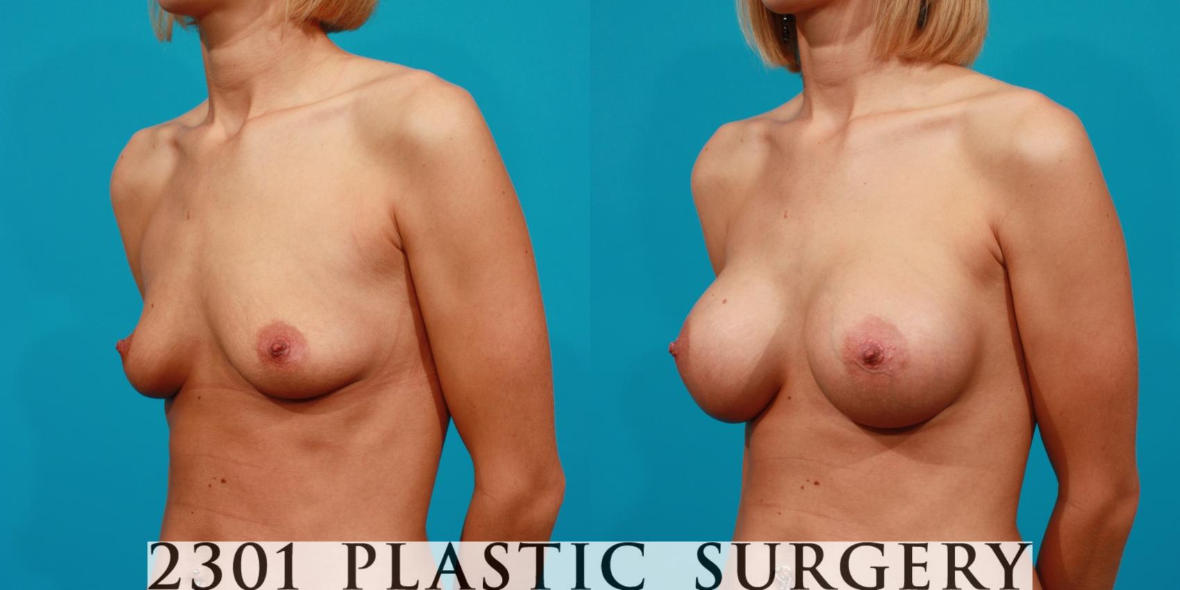 Before & After Saline Implants Case 86 View #3 View in Fort Worth & Frisco, Texas