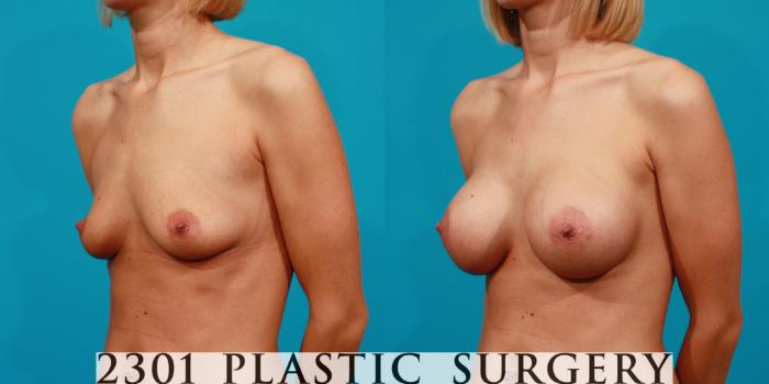 Before & After Saline Implants Case 86 View #3 View in Fort Worth, Plano, & Frisco, Texas
