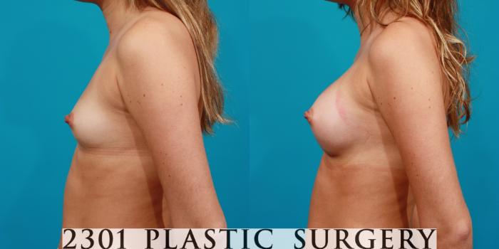 Before & After Saline Implants Case 87 View #2 View in Fort Worth, Plano, & Frisco, Texas